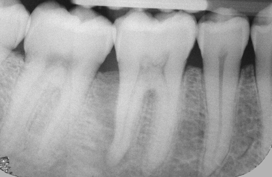 Fig. 2: On the radiograph,
a radiolucency along the distal wall of the distal root with the typical J shape seen in vertical root fractures could be observed.