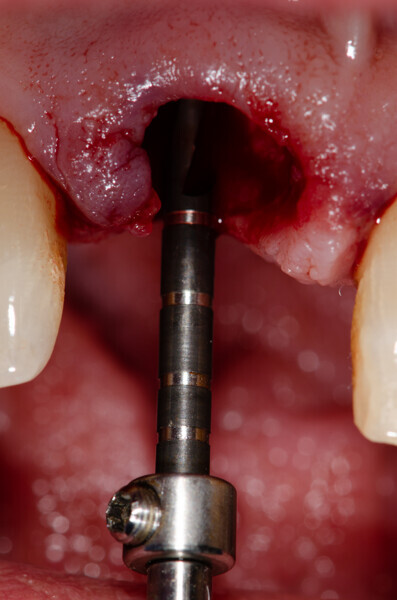 Fig. 14: Guide drill in the extraction socket, anterior view.
