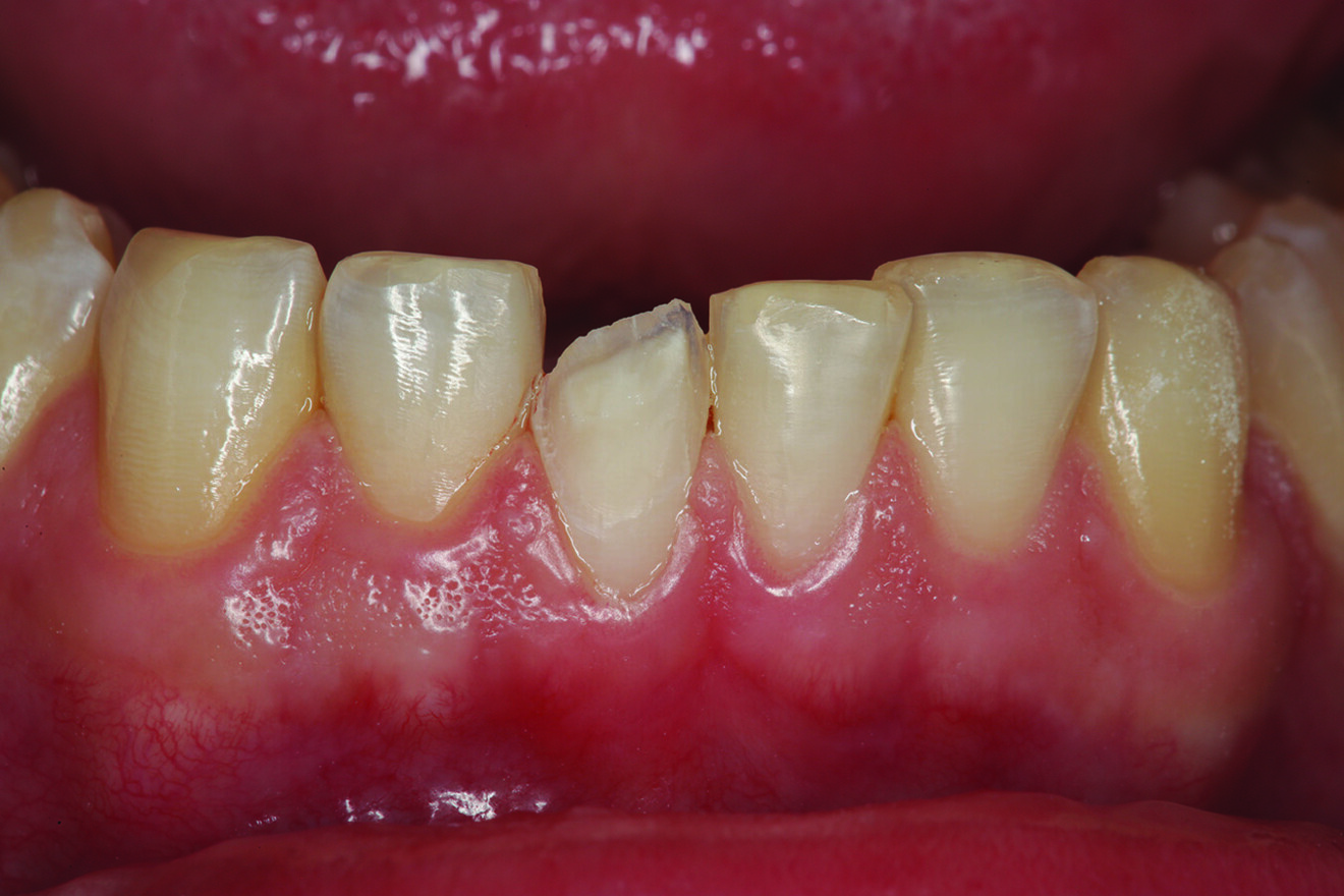Fig. 5: Tooth #41 orthodontically prepared on the facial aspect to create space so that restoration of that surface could correct the facial position of the tooth in the occlusion.