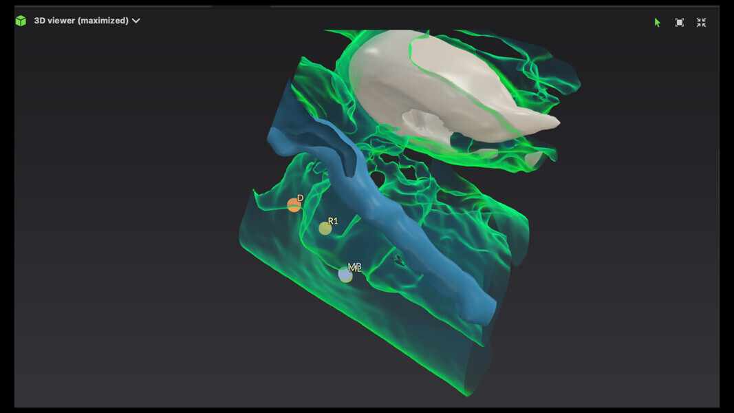 Fig. 15: 3D reconstruction showing that the nerve bypassed the buccal area and only touched the middle part of the mesial canal.