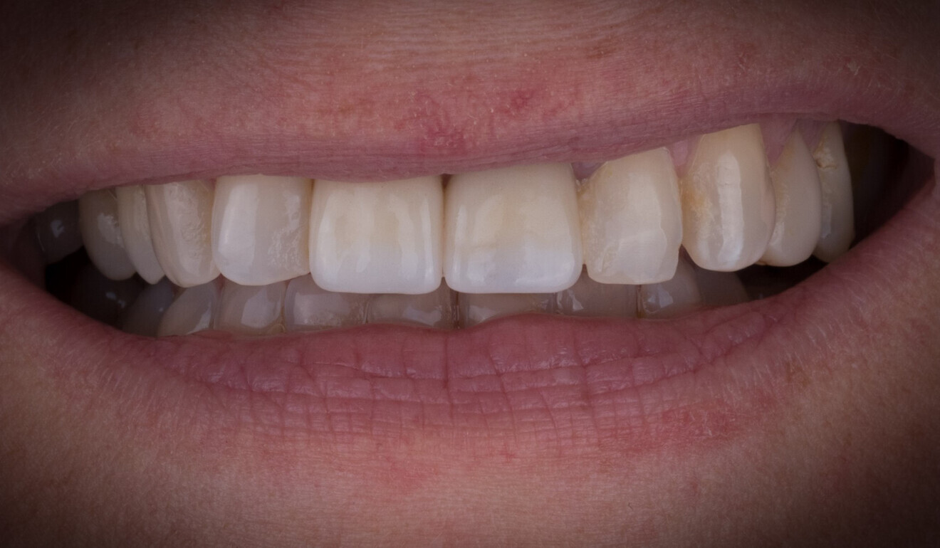 Fig. 11: Patient’s smile at a recall after four months. (Image: Emmanuel Charleux)