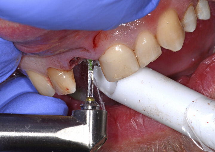Fig. 10: Removal of the granulation tissue with an Er:YAG laser.