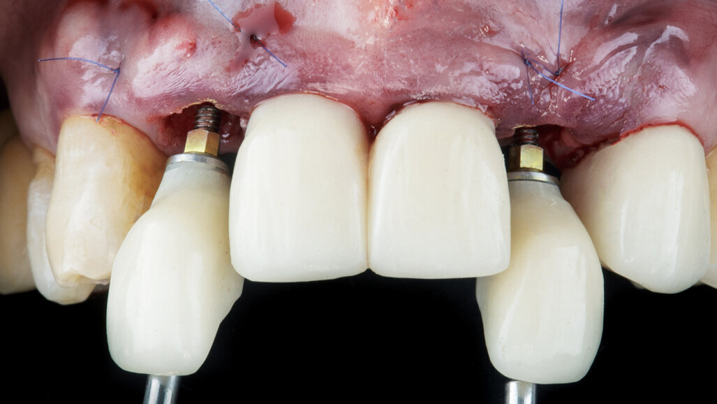 Immediate loading protocols are supporting global expansion of dental implants