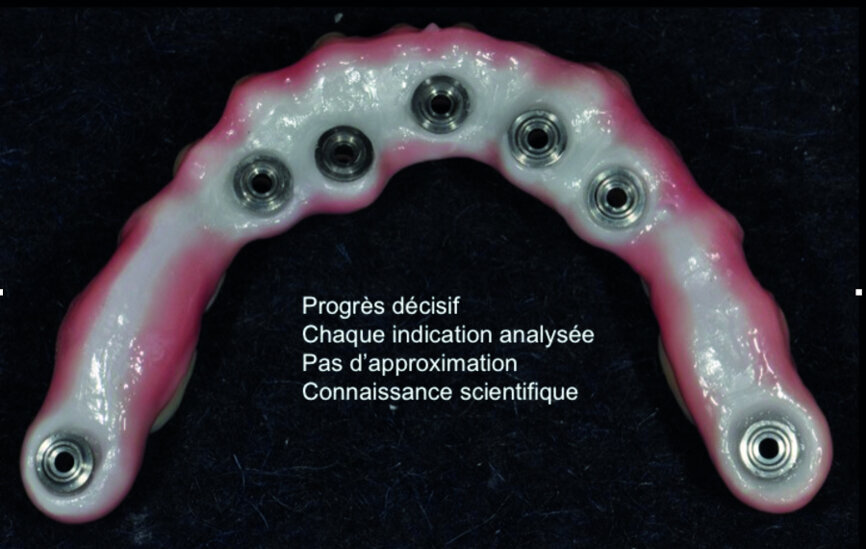Figure 5 : Bridge en « full zircone maquillée », à noter le collage intraarmature de bague en titane, afin d’assurer une interface titane/titane entre les implants et le bridge. 