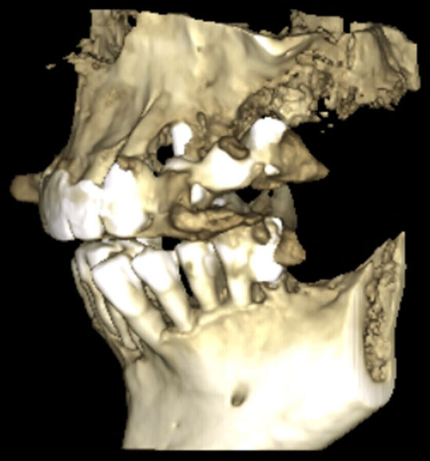 Fig. 3. ReconstrucciÃ³n tridimensional a partir de TCHC. Vista lateral donde se observa la periimplantitis del implante 24 y proceso patolÃ³gico sinusal