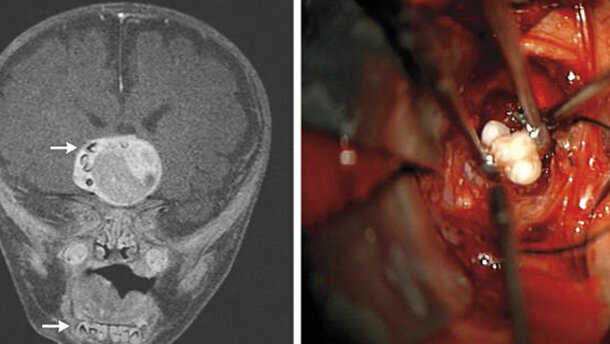 Chirurghi trovano denti nel tumore cerebrale di un bambino