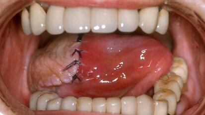 Mikrochirurgie bei Gesichtsrekonstruktion