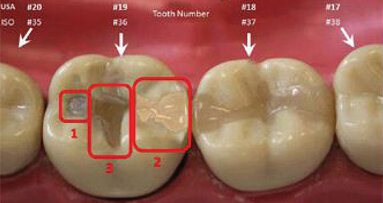 Protocol for forensic dental data now same as for DNA and fingerprinting