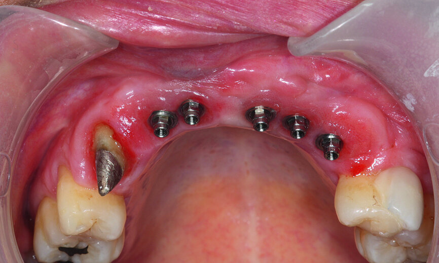 Fig. 31: Removal of the validation prosthesis and examination of the
areas of compressed mucosa and difficult for dental hygiene. Reinstallation of validation prosthesis after correction.