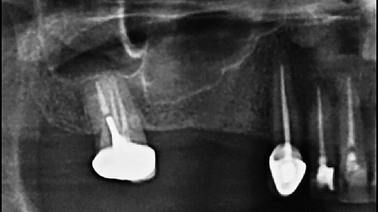 Elevace čelistní dutiny pomocí krátkého implantátu