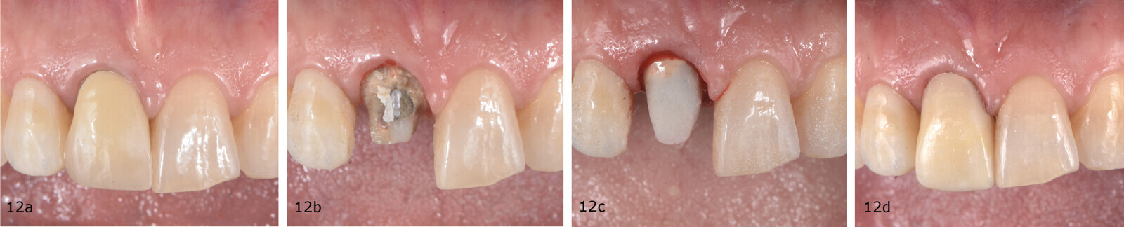 Figs. 12a–d: Removal of the old crown on tooth #11, build-up and tooth preparation following the biologically oriented preparation technique.