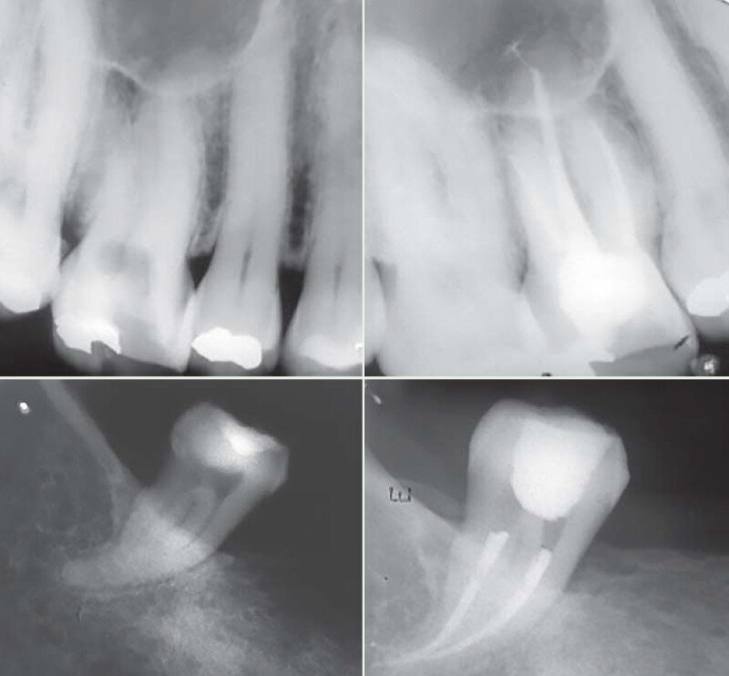 Figs. 1 : Cas clinique réalisé avec le système Genius (c Dr Carlos Spironell Ramos).
