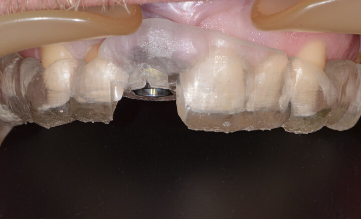 Fig. 12: Tooth-supported Simplant Guide.