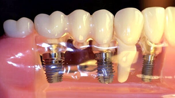 Fila de implantes