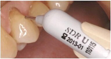 El manejo de la sensibilidad antes, durante y después del tratamiento de aclaramiento dental