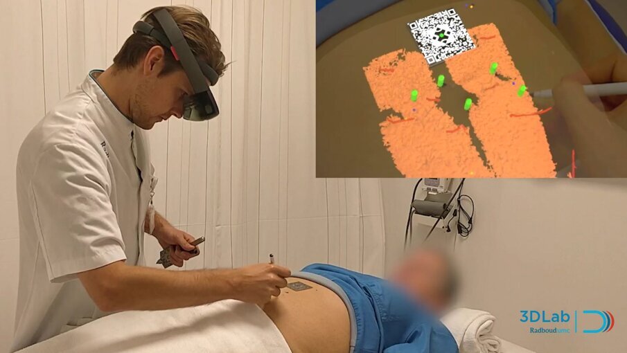 Afbeelding 1. Augmented reality-applicatie om belangrijke bloedvaten te visualiseren voorafgaand aan een borst-reconstructie (reconstructie met vetweefsel uit de buik van de patiënt).