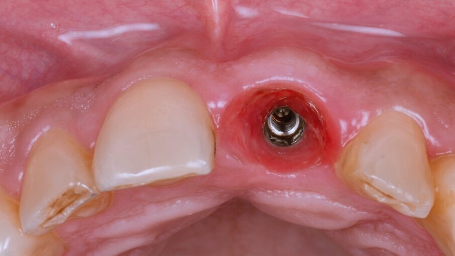 Udatta Kher socket shield 5