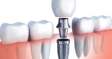 Los implantes dentales, entre los tratamientos odontológicos más demandados en 2020