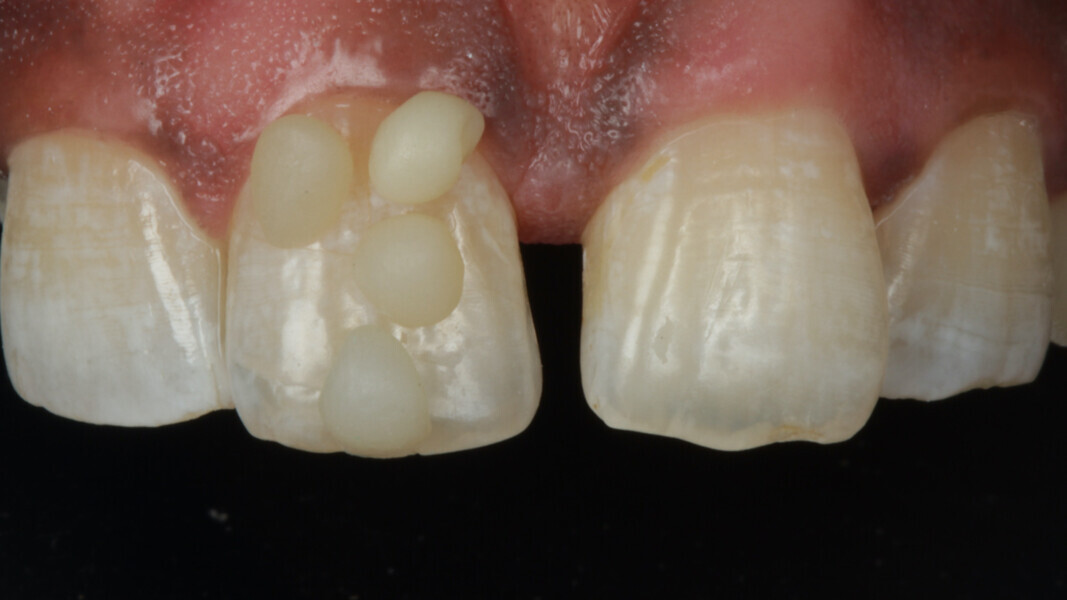 Fig 2: Shade was evaluated with the “Button technique”. Various shades of composite to be used are applied in a button or disk shape on the tooth and light cured. The shade that is the most inconspicuous is selected. In this case, A3.5 Body for cervical region and A3 Body for middle and incisal thirds is selected. A point to be noted here is to select the shade before any procedure or rubber dam to avoid any discrepancy due to dehydration.