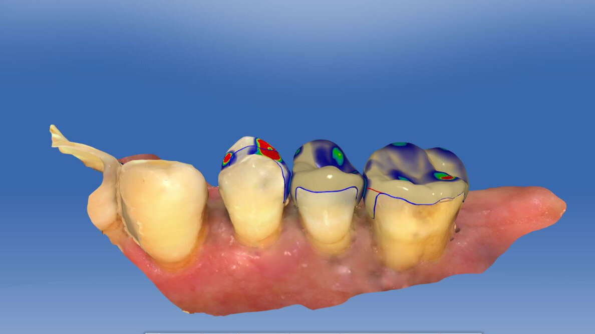 Mill, polish, seat! Indirect procedures in the dental workflow
