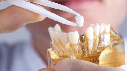 Türk Bilim İnsanından Dental İmplant Tedavisinde Yeni Buluş