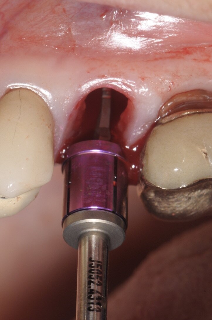 Fig. 4 - Preparazione del sito implantare con la fresa del diametro dell’impianto impiegato.