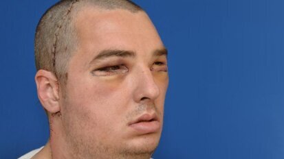 Dental, facial reconstructive surgeons perform most extensive full-face transplant