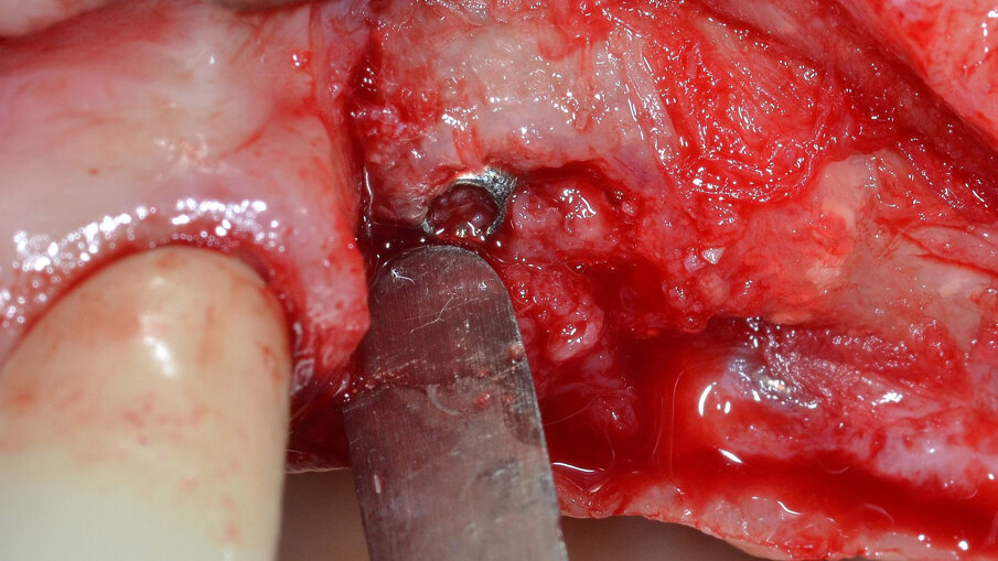 Fig. 12 - Esame RX endorale e sondaggio parodontale postoperatorio.