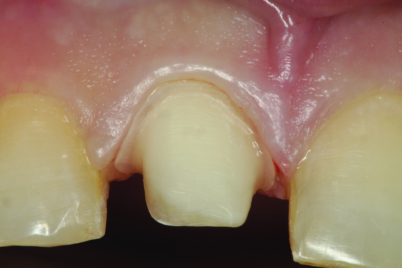 Fig. 11b: Facial view of the completed preparation of tooth #11.