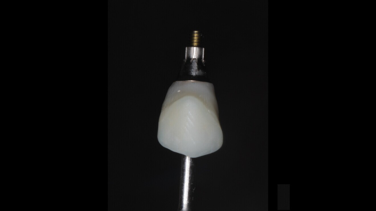 Fig. 11: 3D-printed shell picked up using flowable composite and ready to deliver on the day of surgery.
