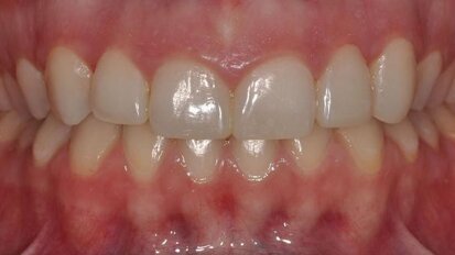 Enhancement of aesthetic treatment planning and communication using a diagnostic mock-up