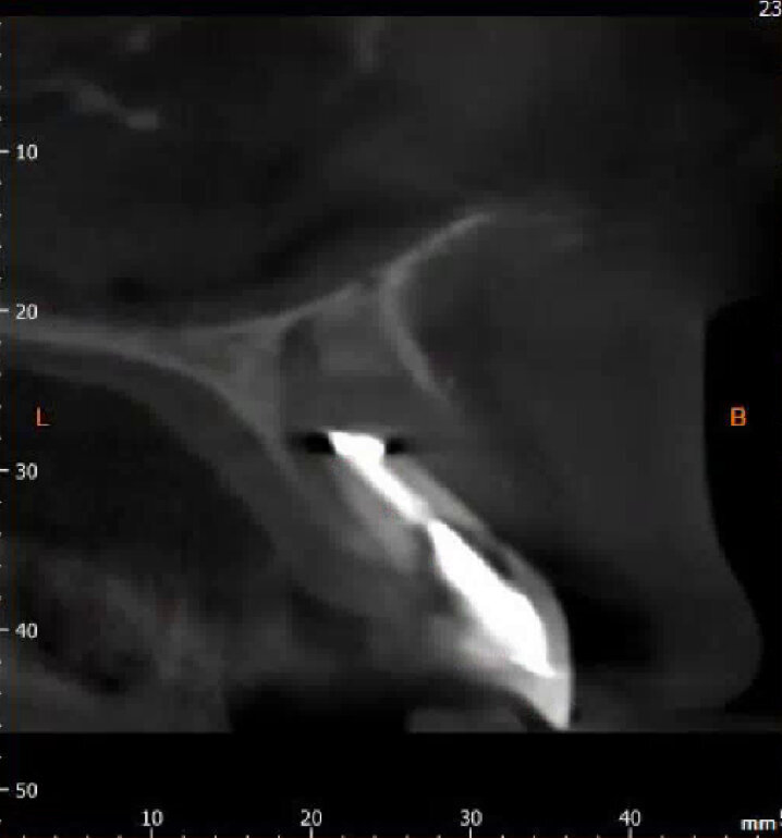 Fig. 4: 3-D X-ray.