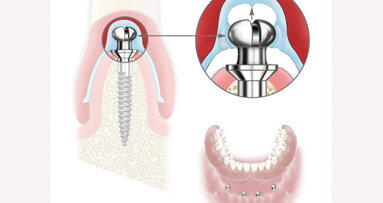 Atlas Denture Comfort secures new or existing dentures