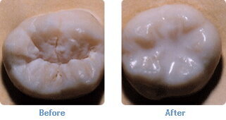 Dental sealants: They are not just for kids anymore