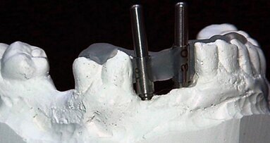 An in-office-fabricated implant surgical guide corrected using CBCT
