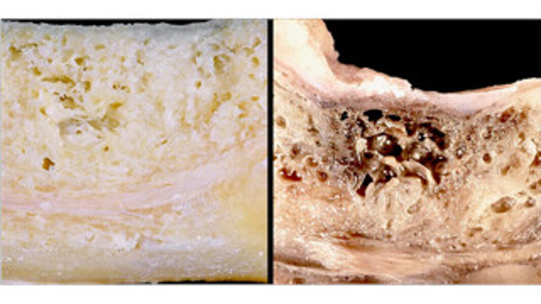 Fig. 1 : Image comparative d’un os mandibulaire sain à gauche et d’un os atteint de DFOJ à droite (© Dr Jerry E. Bouquot).