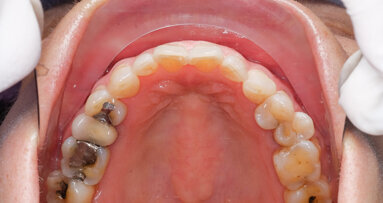 US Environmental Protection Agency reinstate amalgam management ruling
