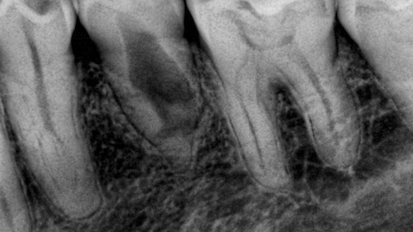 Obturación tridimensional de reabsorción interna