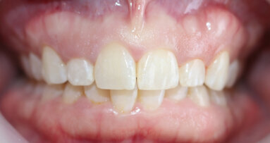 Aesthetic crown lengthening, exostosis removal and veneer restorations