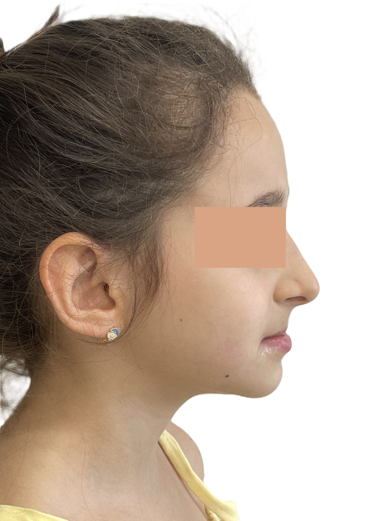 Figs. 1a–c: Pre-treatment records. Extra-oral photographs. 