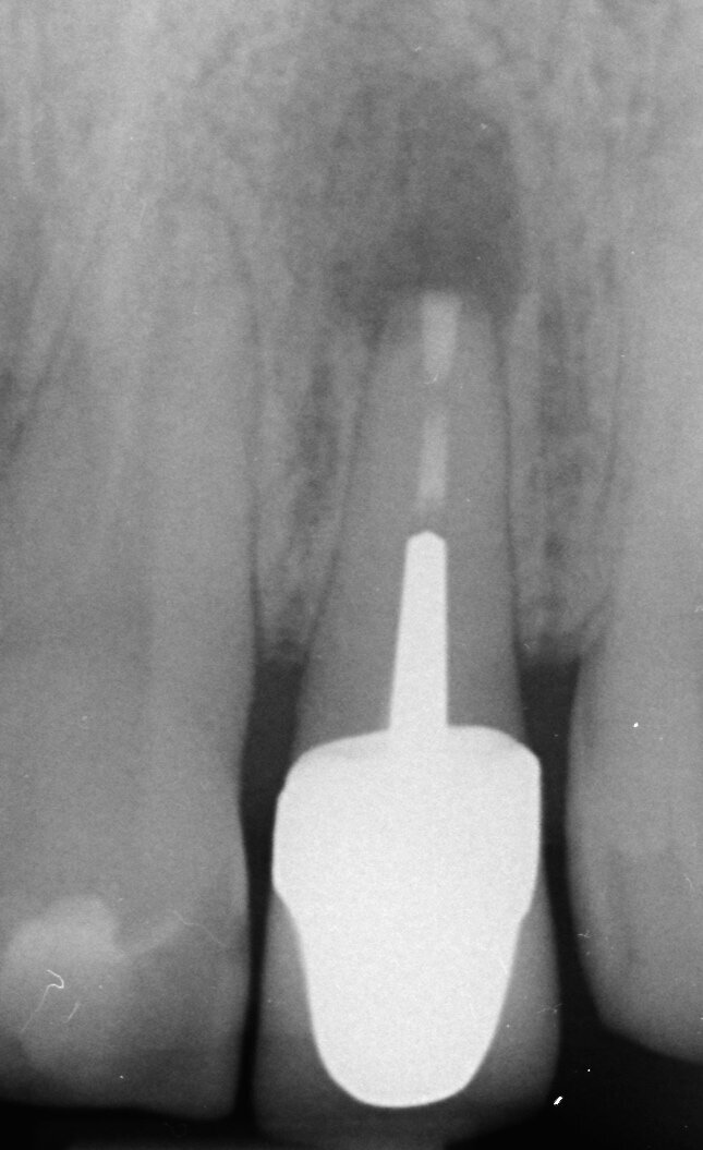 Fig. 4f: (a) Pre-op radiograph with a large periradicular lesion. (b) Periapical surgery. (c) MTA application with the MAP System and PD MTA White. (d) Condensation of the MTA with pluggers. (e) Mirror view of the root-end cavity filled with MTA. (f) Post-op radiograph showing the root-end filling.