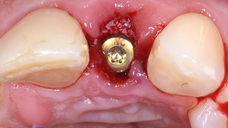 Dr Stephen Chen on principles for case selection in post-extraction implant placement