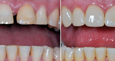 Carillas prefabricadas en dientes anteriores
