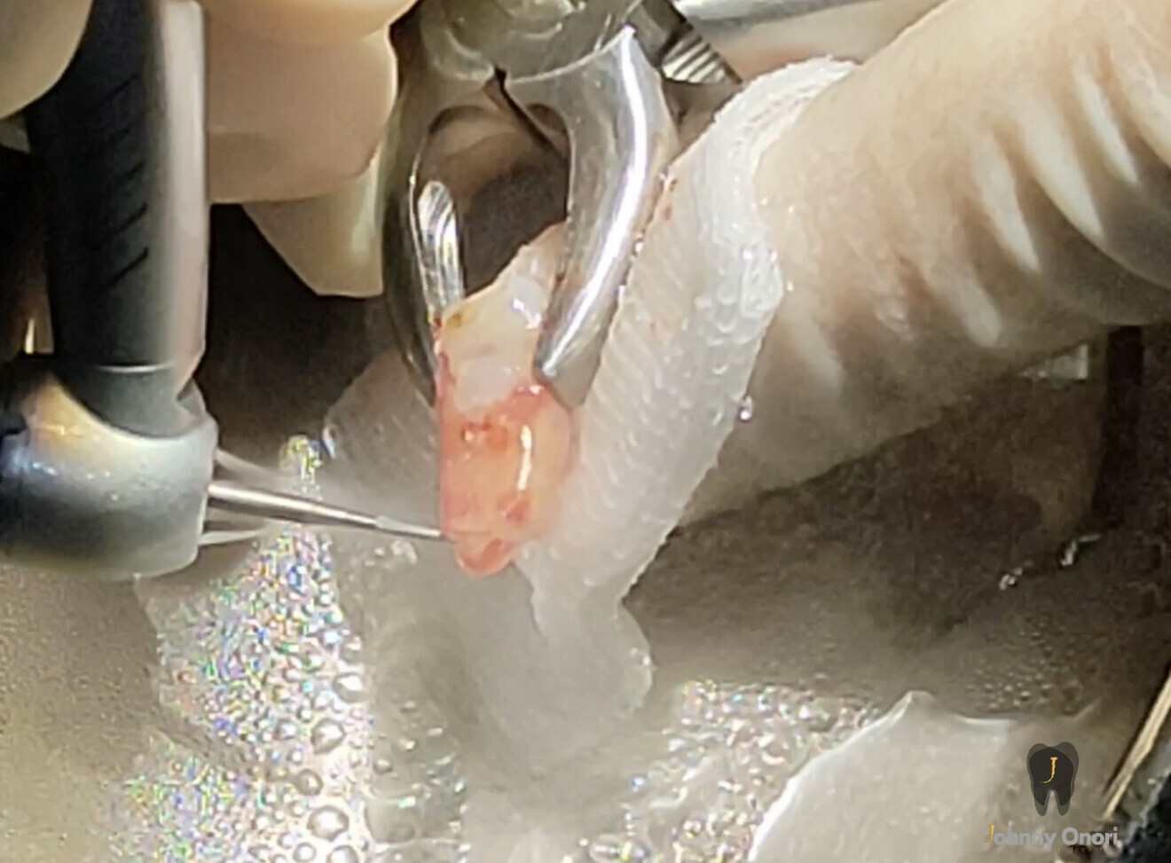 Figs. 5a–d: Apical surgery. Retro-preparation with ultrasonic tips (a & b) and retro-obturation with CeraPutty (Meta Biomed; c & d).