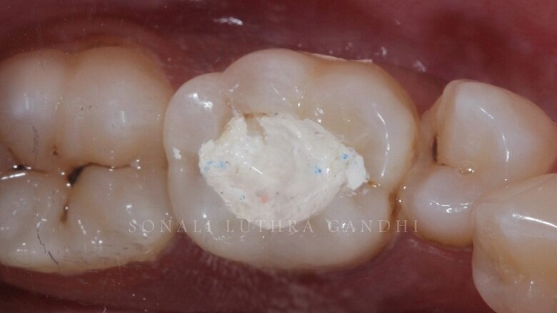 Fig 1: Pre-operative photograph