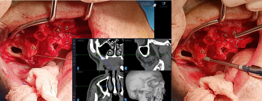 Figs. 6a & b: Placement of the first-quadrant zygomatic implant with the help of the navigation instrument.