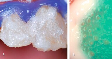 Estética y blanqueamiento dental en la era digital (Capítulo 3)