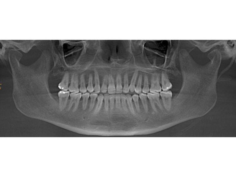 Fig. 4: Pretreatment dental panoramic tomogram.