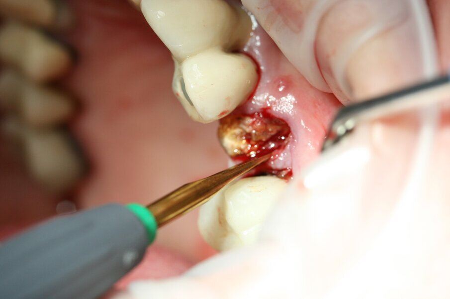 Fig. 7: We continued to luxate with Luxator P1 (straight blade, dark green) until the root felt sufficiently loose.