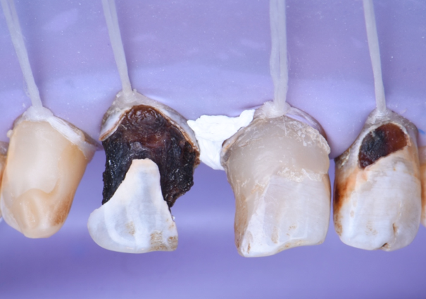 Step 2 – Isolation After shade selection (A3) the anterior area was isolated with rubber dam and stabilised with knot ligatures for preventing leakage and adequate retraction teflon tape used. 